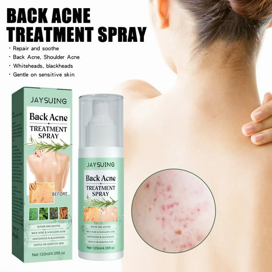 Acne Spray